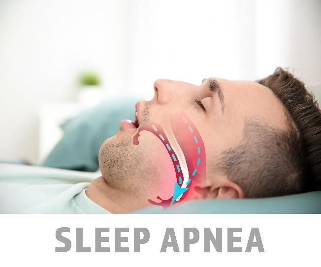 Treating of sleep apnea 